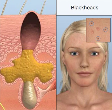 Khi bị mụn đầu đen phải chăm sóc da như thế nào?